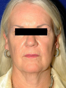 before facelift female patient front view case 2260