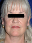 after facelift female patient front view case 2260