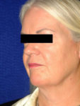 before facelift female patient left angle view case 2260