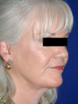 after facelift female patient right angled view case 2260