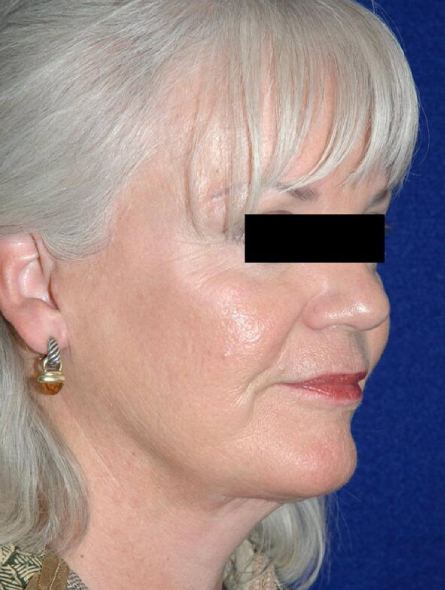 after facelift female patient right angled view case 2260