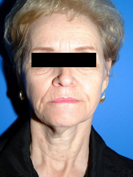 before facelift female patient front view case 2265