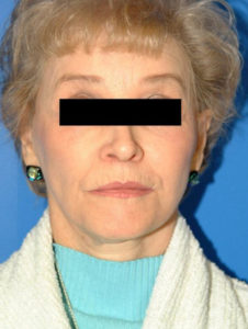 after facelift female patient front view case 2265