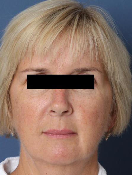 before facelift female patient front view case 2269