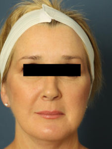 after facelift female patient front view case 2269