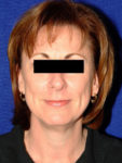 before facelift female patient front view case 2276