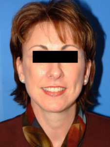 after facelift female patient front view case 2276