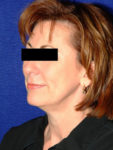 before facelift female patient left angled view case 2276