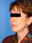 after facelift female patient left angled view case 2276