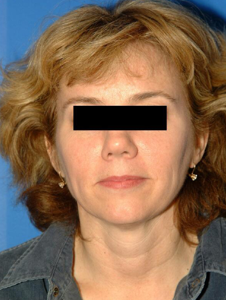 before facelift female patient front view case 2281