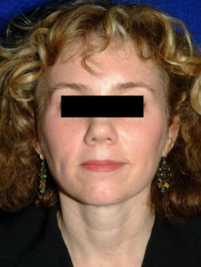 after facelift female patient front view case 2281