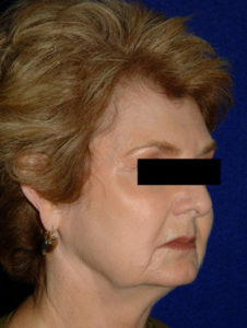 before facelift female patient right angle view case 2285