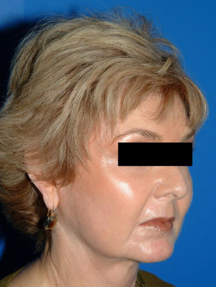 after facelift female patient right angled view case 2285