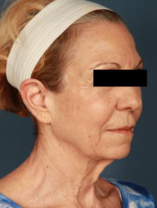before facelift female patient right angled view case 2289