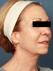 after facelift female patient right angled view case 2289
