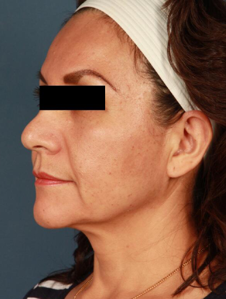 before facelift female patient left angled view case 2292