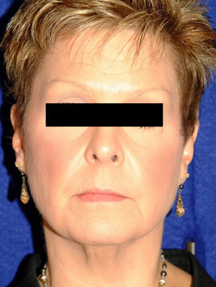 before facelift female patient front view case 2295