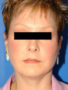 after facelift female patient front view case 2295