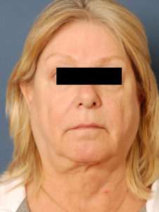 before facelift female patient front view case 2298