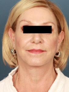 after facelift female patient front view case 2298