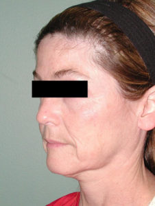 before facelift female patient left angle view case 2301