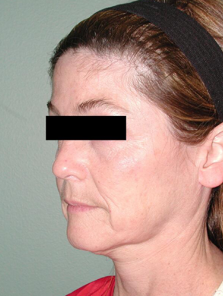 before facelift female patient left angle view case 2301