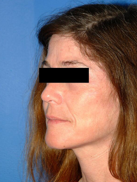 after facelift female patient left angle view case 2301