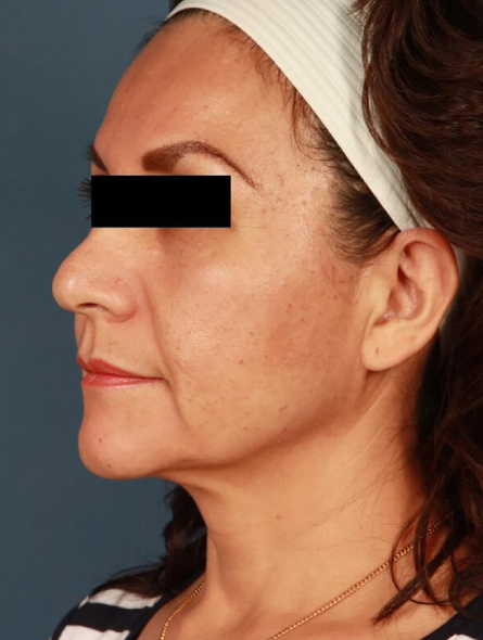before facelift female patient left angle view case 2304