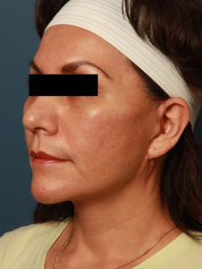 after facelift female patient left angle view case 2304
