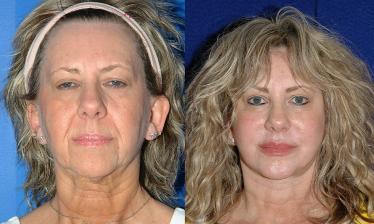 before and after facelift female patient front view