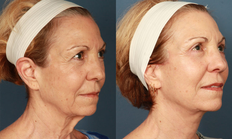 before and after facelift female patient right angled view