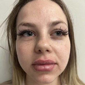 after lip filler case 1605