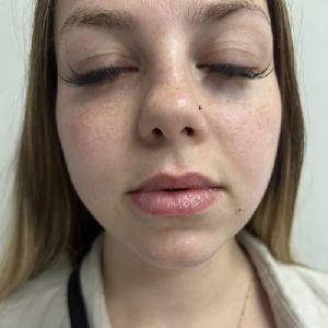 before lip filler case 1605