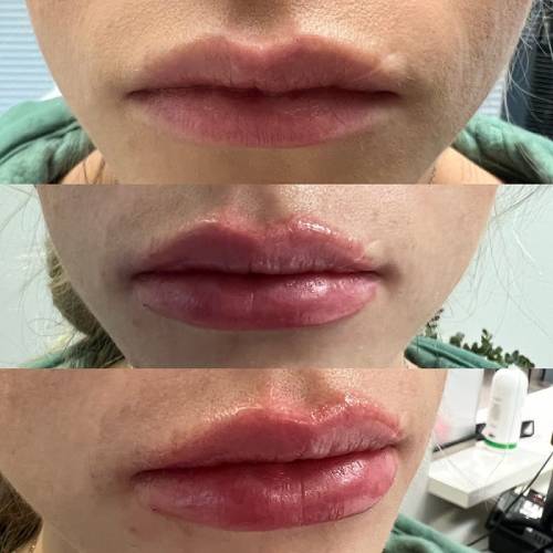 before and after lip filler multiple angled view case 1609
