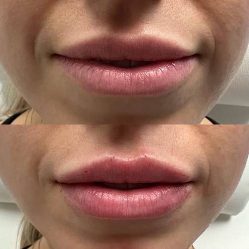 before and after lip filler case 1611