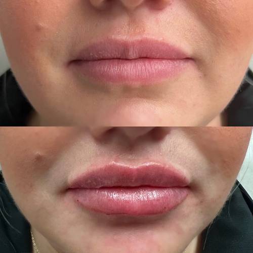 before and after lip filler case 1615