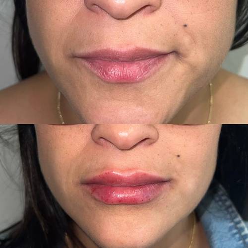 before and after lip filler closeup case 1617