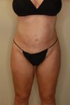 after liposuction female patient front view case 2267