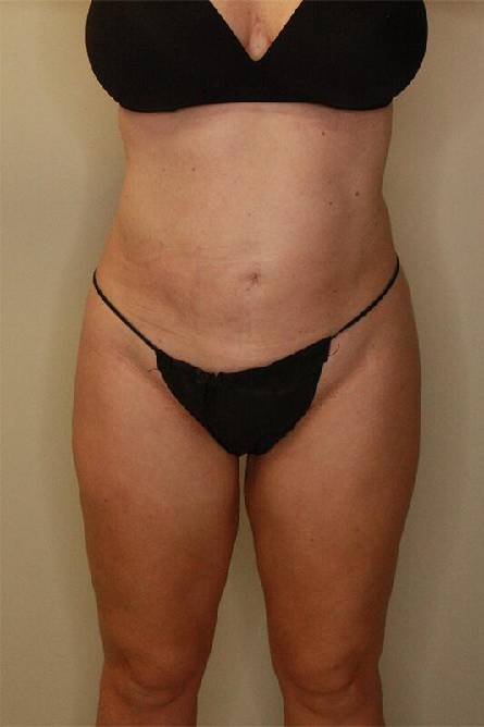 after liposuction female patient front view case 2267