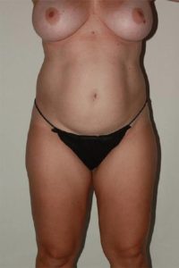 before liposuction female patient front view case 2267