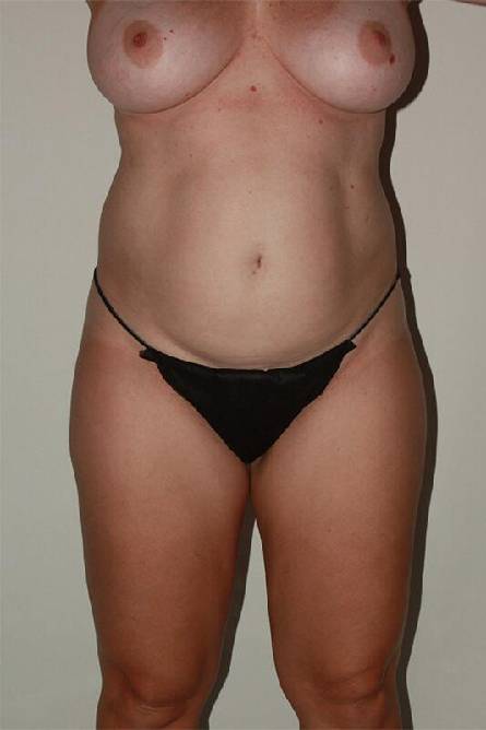 before liposuction female patient front view case 2267
