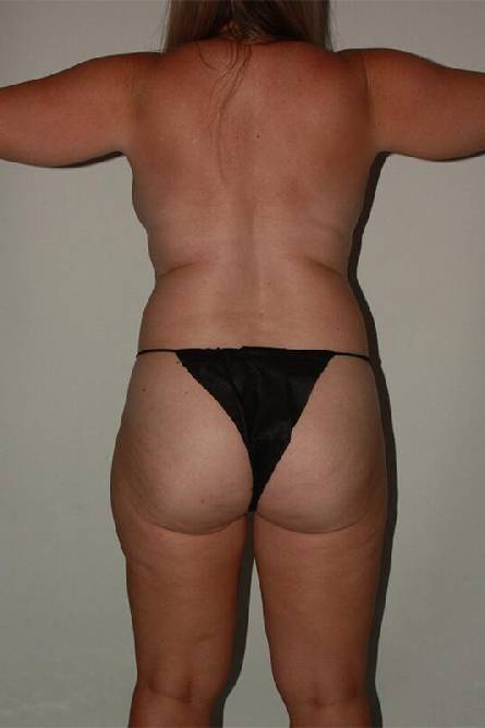 before liposuction female patient back view case 2267