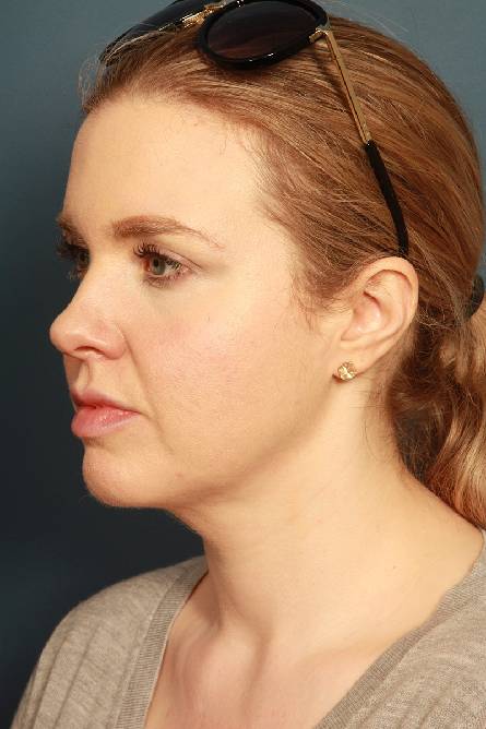 after liposuction female patient left side view case 2288