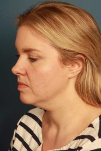 before liposuction female patient left side view case 2288