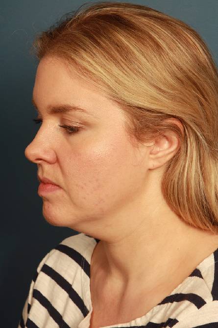 before liposuction female patient left side view case 2288