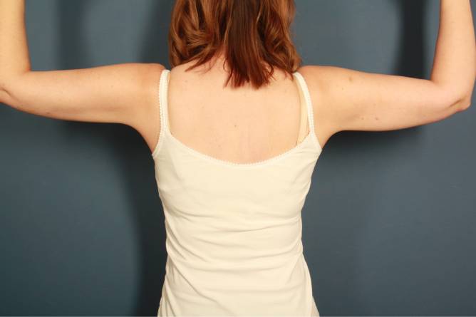 after liposuction female patient back of arms view case 2309