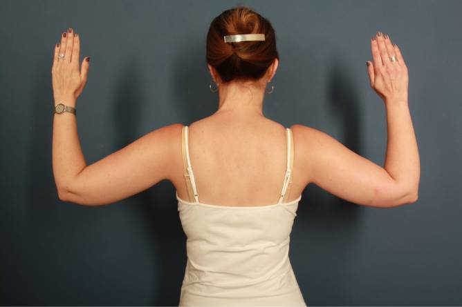 before liposuction female patient back of arms view case 2309