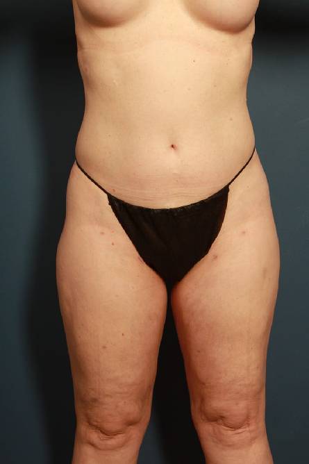 after liposuction female patient front view case 2312