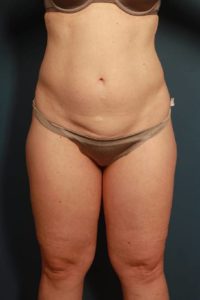 before liposuction female patient front view case 2312
