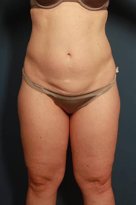 before liposuction female patient front view case 2312
